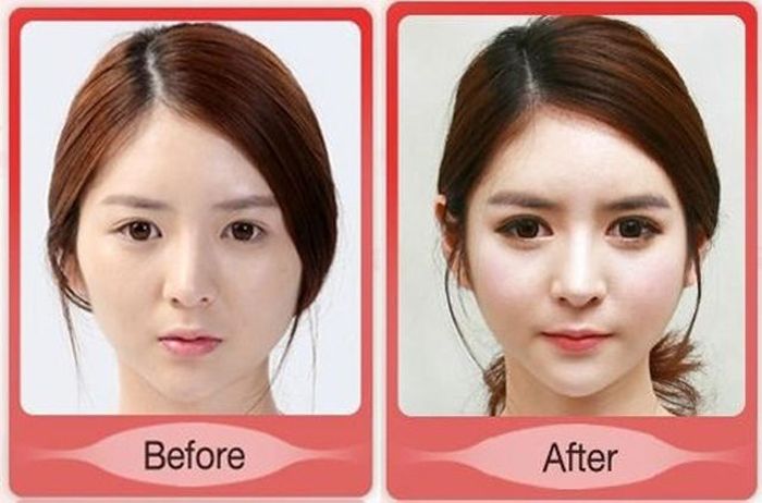 Korean Plastic Surgery Part Pics