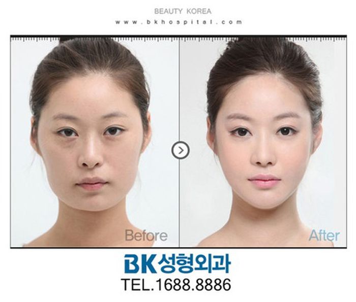 Korean Plastic Surgery Part 2 61 Pics