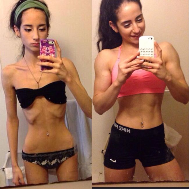 Anorexic Girl Changes Her Life And Completely Transforms Her Body Pics