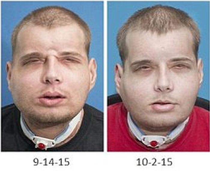 Facial first picture transplant