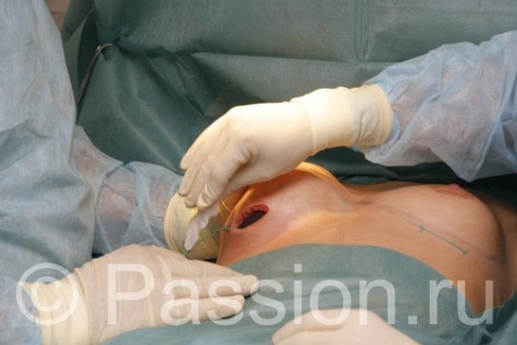 Amazing photos of breast increasing operation...