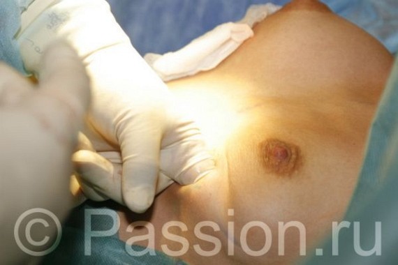 Amazing photos of breast increasing operation...