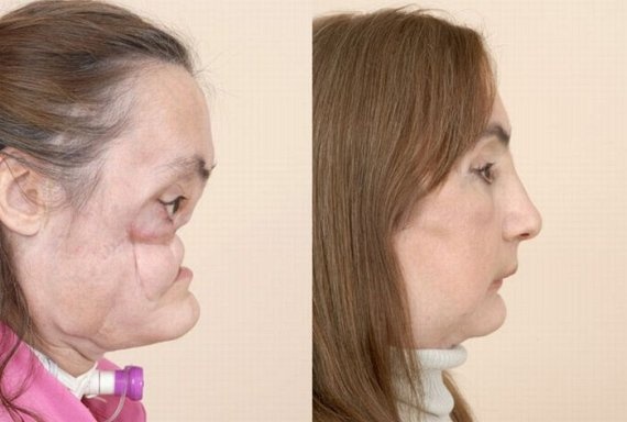 Face Transplant Unveiled After Shotgun Blast
