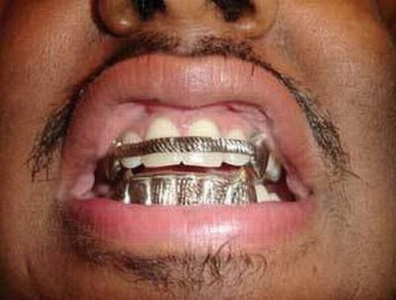 Bling teeth (52 pics)