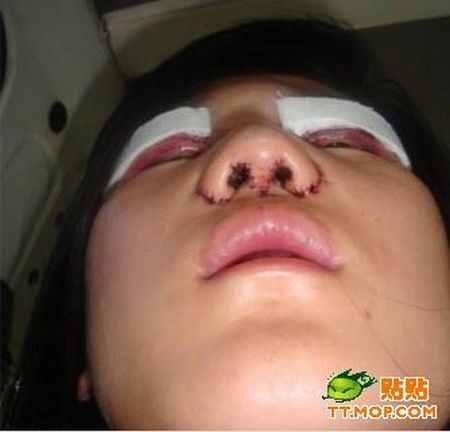 Before And After Cosmetic Surgery (18 pics)