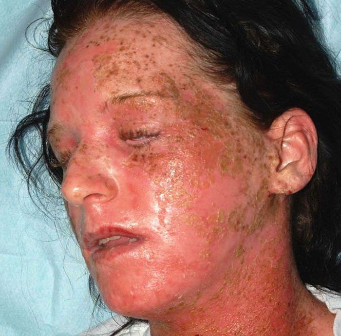 Hair Dye That Caused an Allergic Reaction (6 pics)