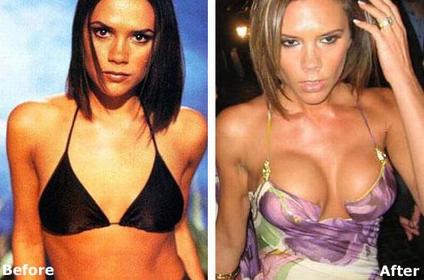 Celebrities Before and After Boob Jobs (15 pics)