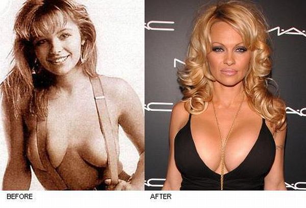 Celebrities Before and After Boob Jobs (15 pics)