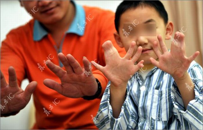 Boy With 34 Fingers (13 pics)