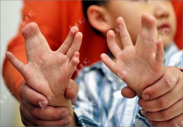 Boy With 34 Fingers (13 pics)