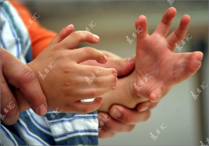 Boy With 34 Fingers (13 pics)