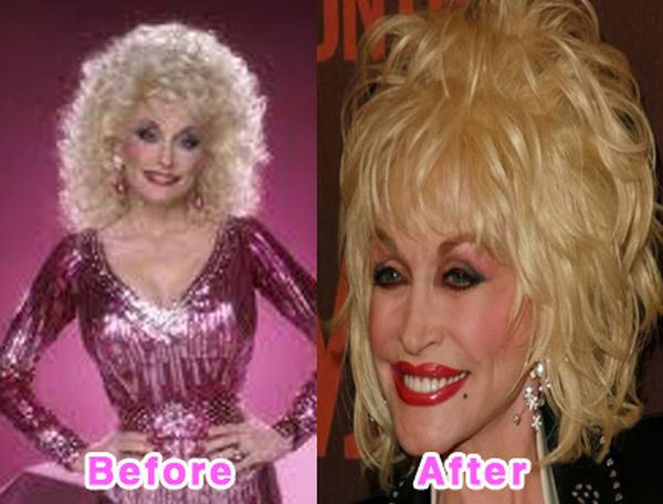 Celebrity Plastic Surgery Disasters. Before And After (16 pics)