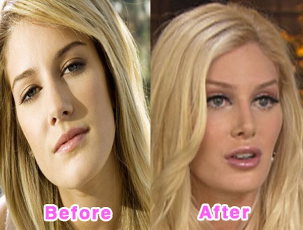 Celebrity Plastic Surgery Disasters. Before And After (16 pics)