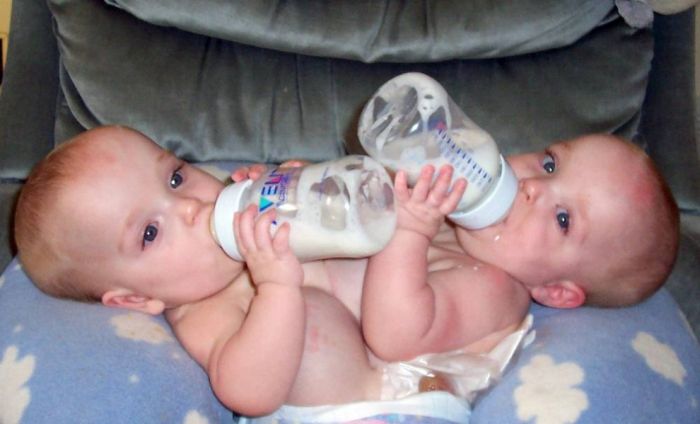 New Life of Conjoined Twins (13 pics)