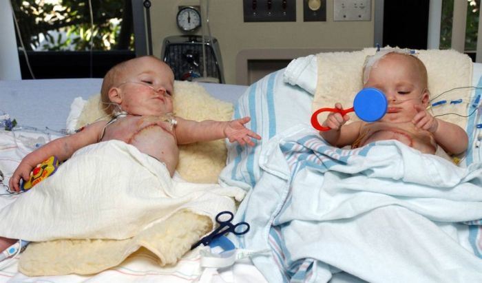 New Life of Conjoined Twins (13 pics)