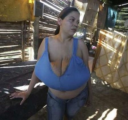 Girl with 20-Pound Breasts (3 pics)