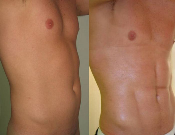 Surgery for a Six-Pack (7 pics)