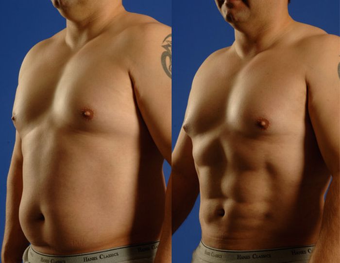 Surgery for a Six-Pack (7 pics)
