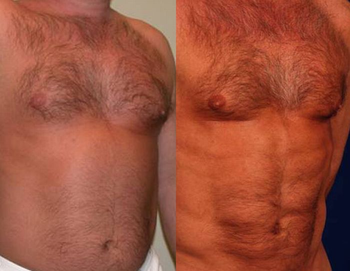 Surgery for a Six-Pack (7 pics)