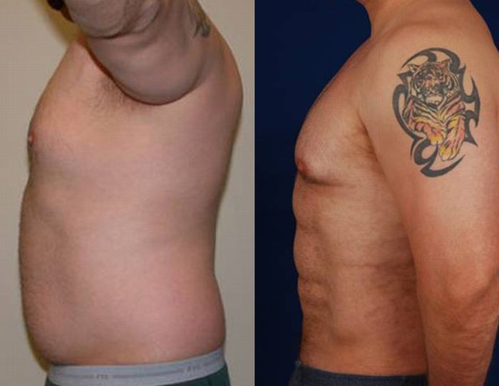 Surgery for a Six-Pack (7 pics)