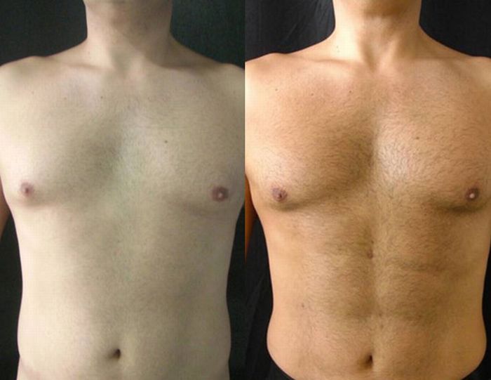 Surgery for a Six-Pack (7 pics)