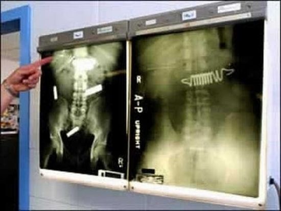 The Strangest Things in Human X-Rays (20 pics)