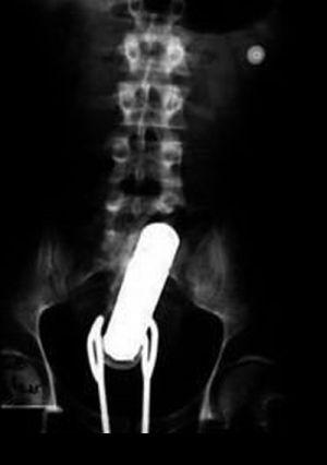 The Strangest Things in Human X-Rays (20 pics)