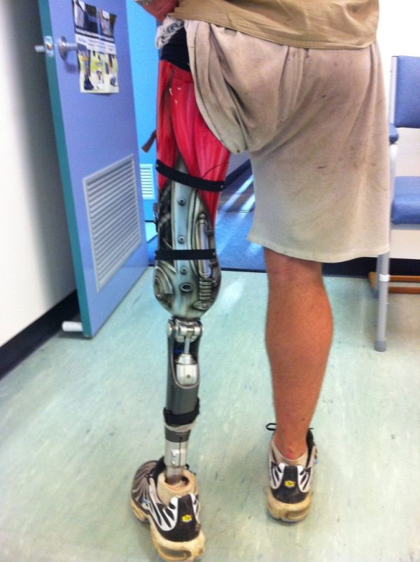 Awesome Prosthetic Leg Pics