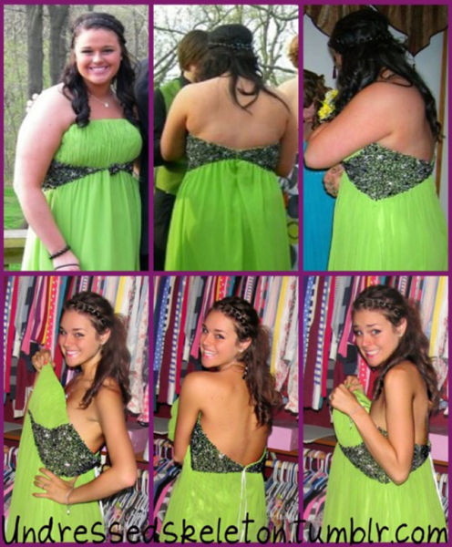 Extreme Weight Loss (10 pics)