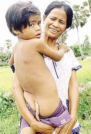 People Born With Tails (8 pics)