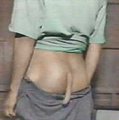 People Born With Tails (8 pics)