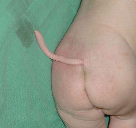 People Born With Tails (8 pics)