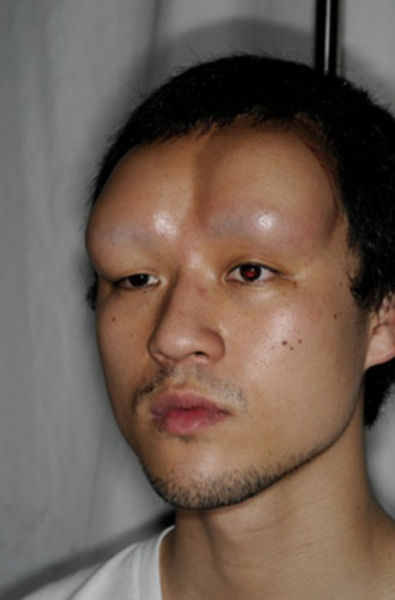 Saline Forehead Injections (8 pics)