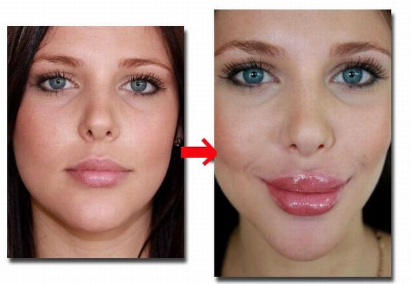 Lip Pump Makes Girl's Lips Bigger (4 pics + video)