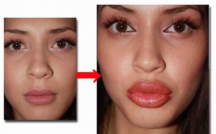 Lip Pump Makes Girl's Lips Bigger (4 pics + video)