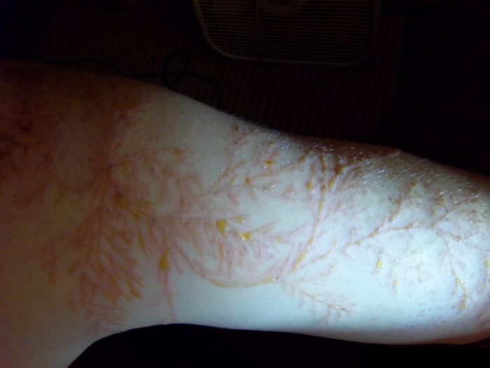 Lichtenberg Figure - Human Skin Struck by Lightning