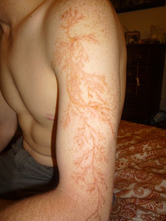 Lichtenberg Figure. Human Skin Struck by Lightning (4 pics)