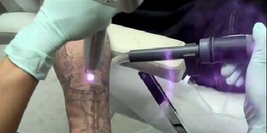 Exciting Way of Laser Tattoo Removal
