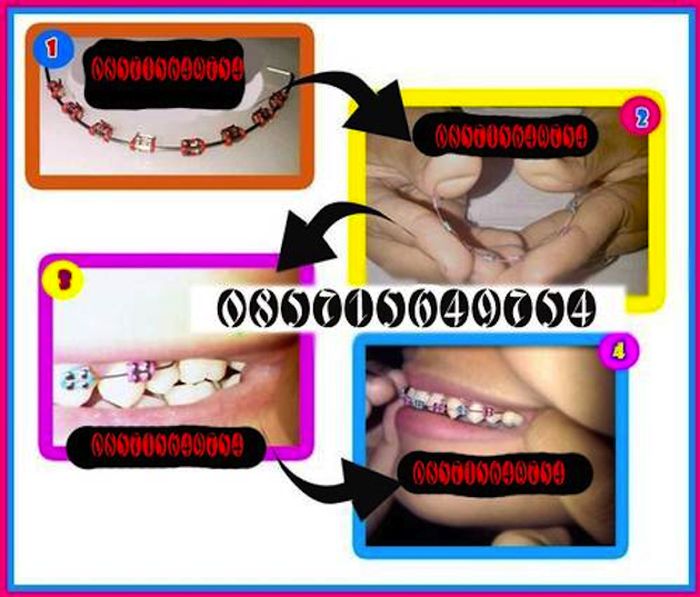 Braces Are New Trend in Asia (8 pics)