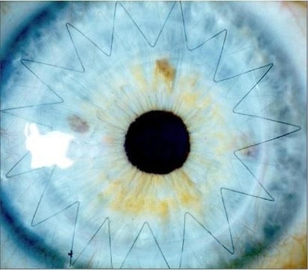 Eyeball Stitches (10 pics)
