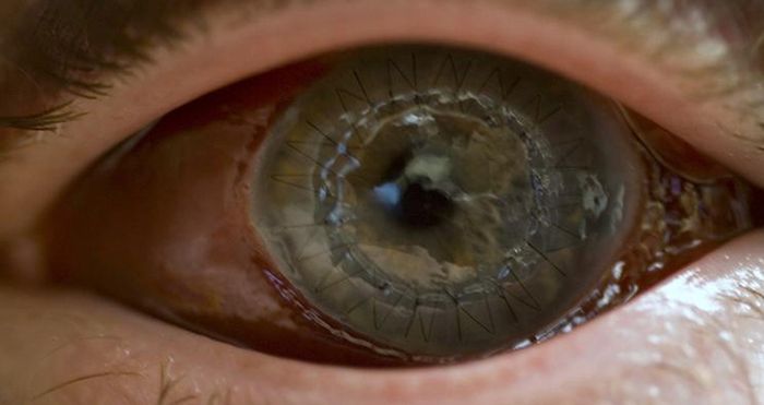 Eyeball Stitches (10 pics)
