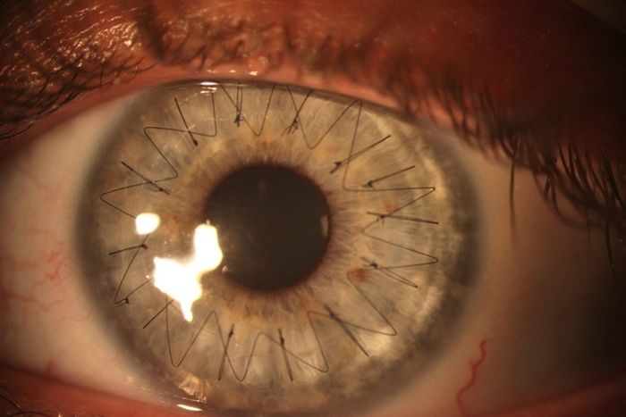 Eyeball Stitches (10 pics)