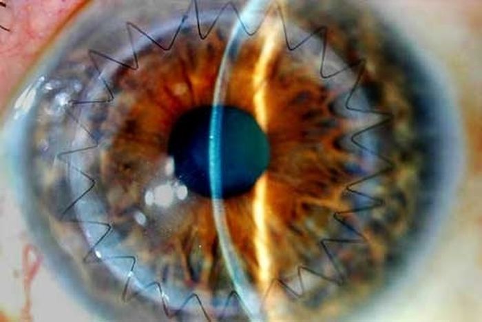 Eyeball Stitches (10 pics)