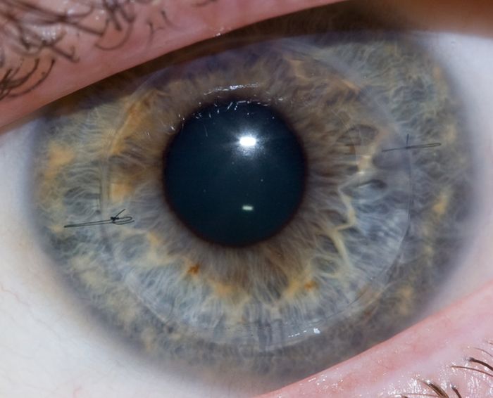 Eyeball Stitches (10 pics)