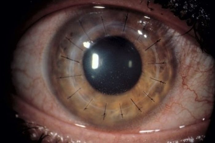Eyeball Stitches (10 pics)