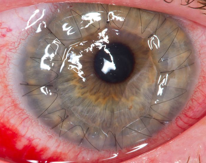 Eyeball Stitches (10 pics)