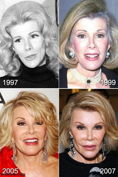 Plastic Surgery Disaster 42 Pics