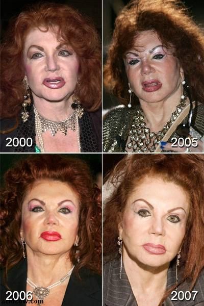 Plastic Surgery Disaster (42 pics)