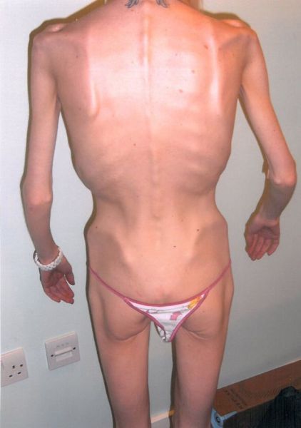 Girl Recovers From Anorexia (9 pics)