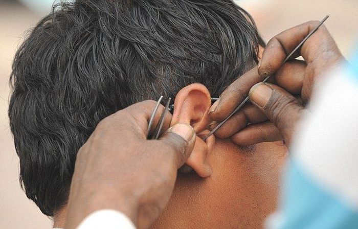 Professional Ear Wax Removal (12 pics)
